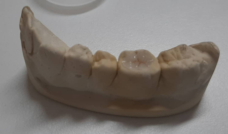 incrustación-dental-porcelana-molde